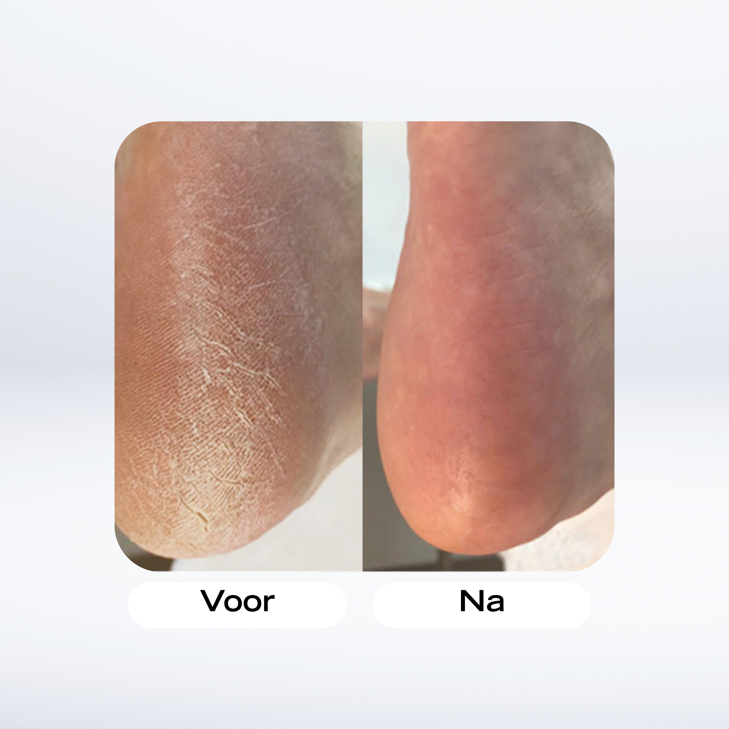 RevitaSpin™ | Professionele Elektrische Eeltverwijderaar